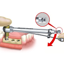 Perfect Smile initial implant stability